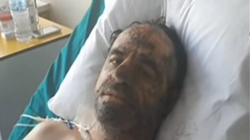 Συγκλονιστική μαρτυρία εγκαυματία της φονικής φωτιάς: Οι φλόγες έτρεχαν σαν δαιμονισμένες